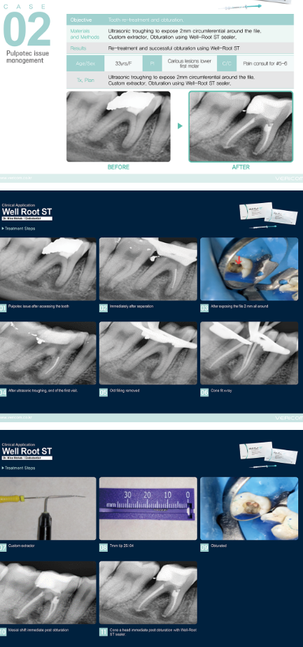 Well-Root ST – Ciment biocéramique endodontique prêt à l'emploi | Vericom