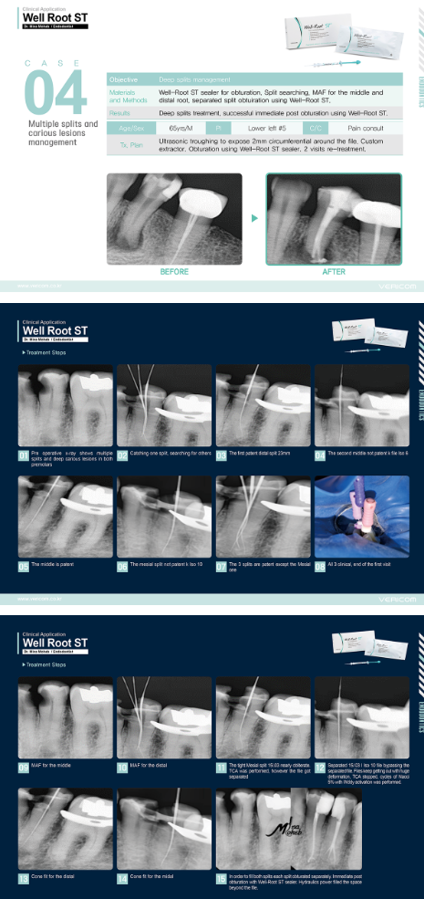 Well-Root ST – Ciment biocéramique endodontique prêt à l'emploi | Vericom