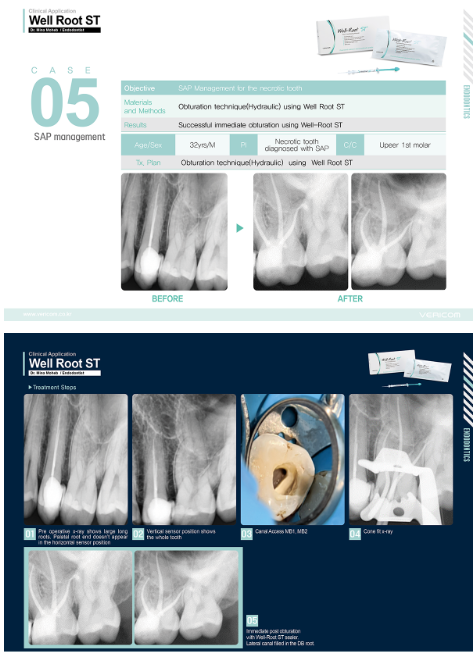 Well-Root ST – Ciment biocéramique endodontique prêt à l'emploi | Vericom