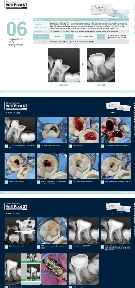 Well-Root ST – Ciment biocéramique endodontique prêt à l'emploi | Vericom