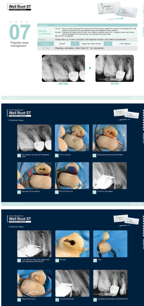 Well-Root ST – Ciment biocéramique endodontique prêt à l'emploi | Vericom