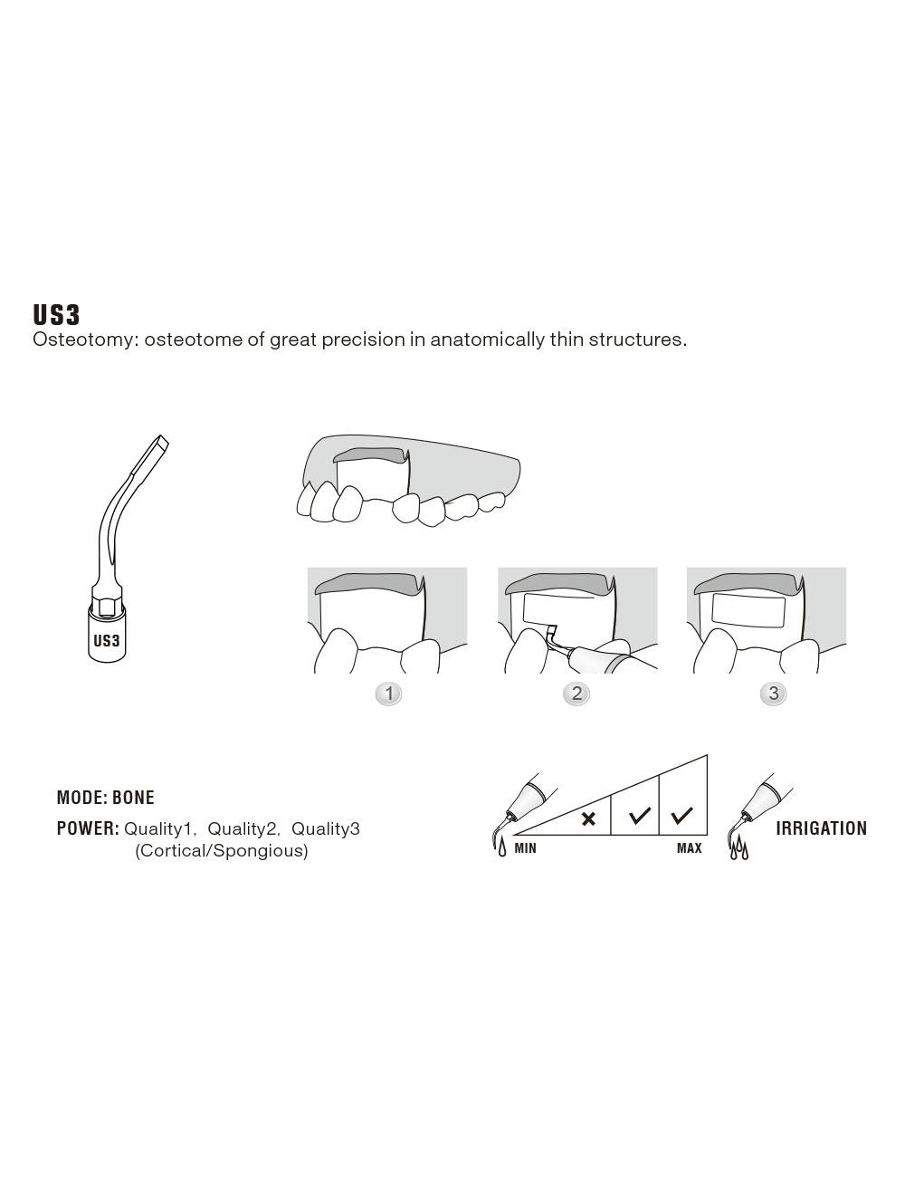 Insert US3 pour chirurgie piezo - WOODPECKER - oofti.fr