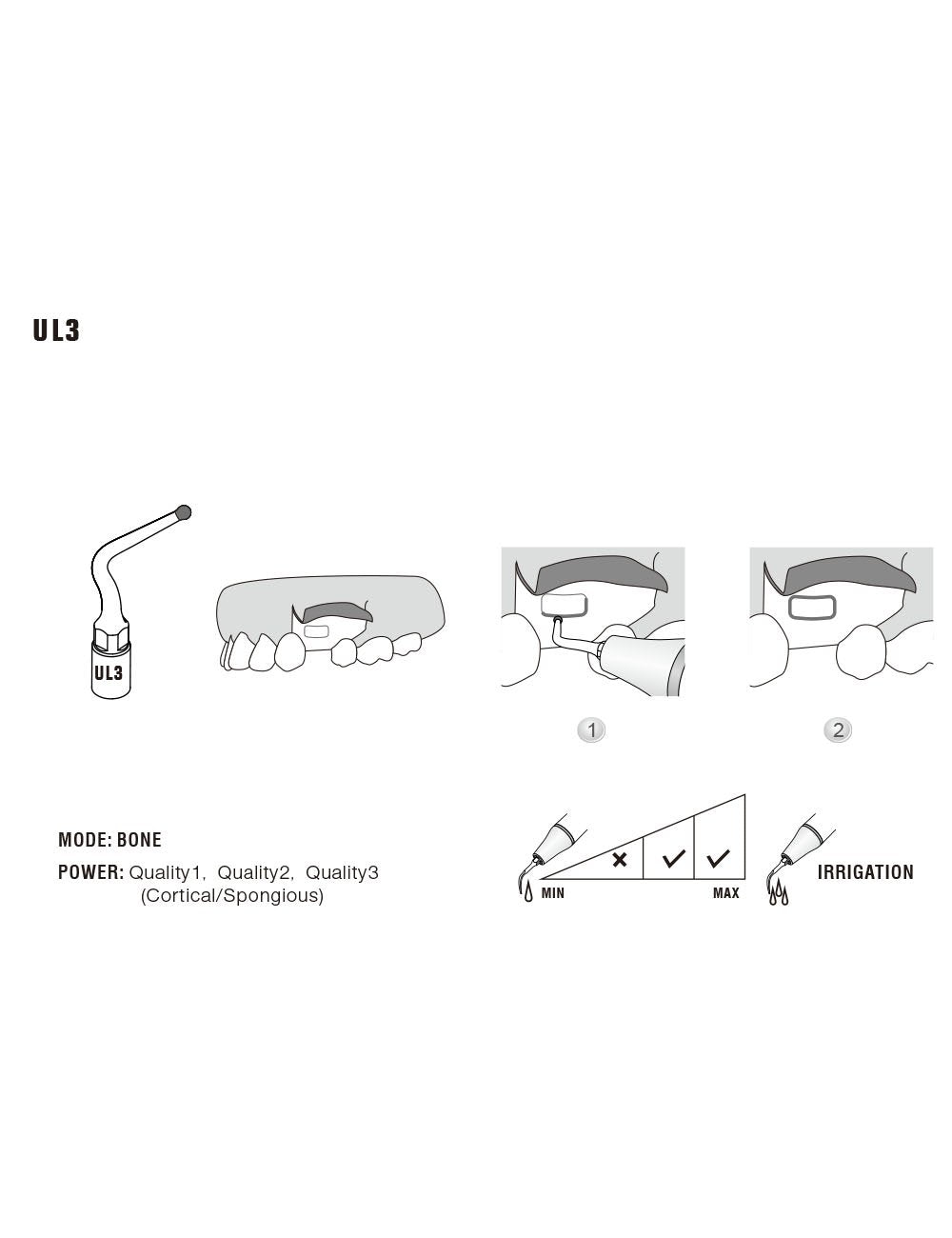 Insert UL3 pour chirurgie piezo - WOODPECKER - oofti.fr