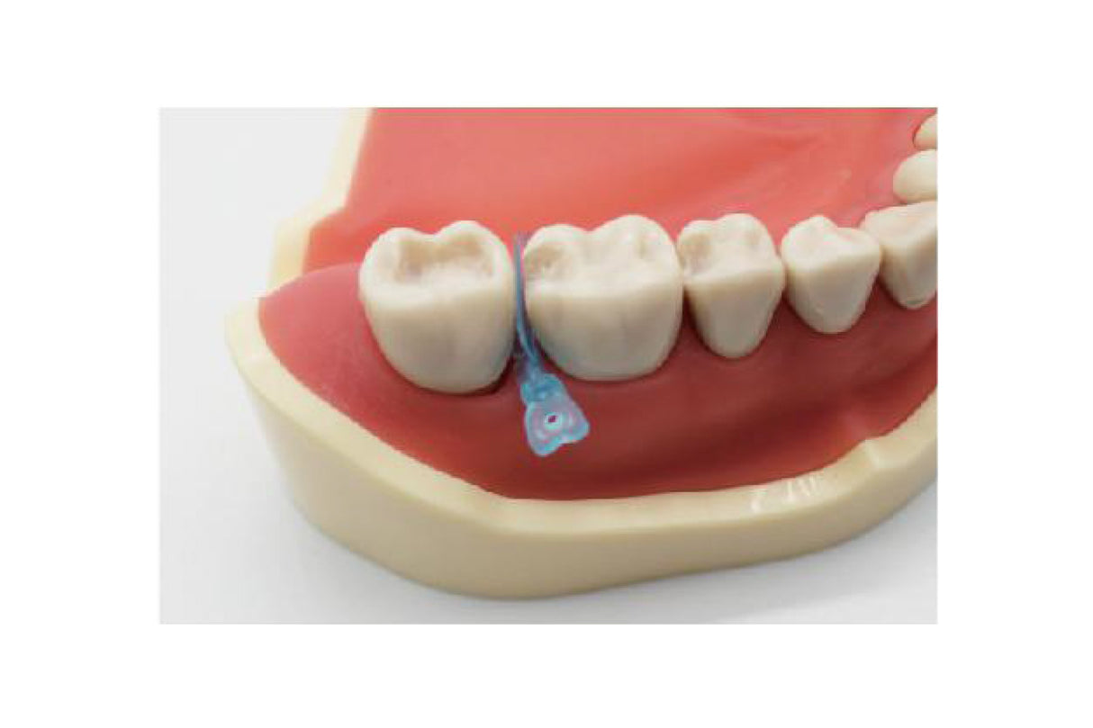 Boîte de 50 cales, coins / matrices interdentaires en plastique 2 en 1 - oofti.fr