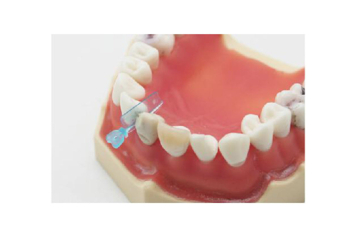 Boîte de 50 cales, coins / matrices interdentaires en plastique 2 en 1 - oofti.fr