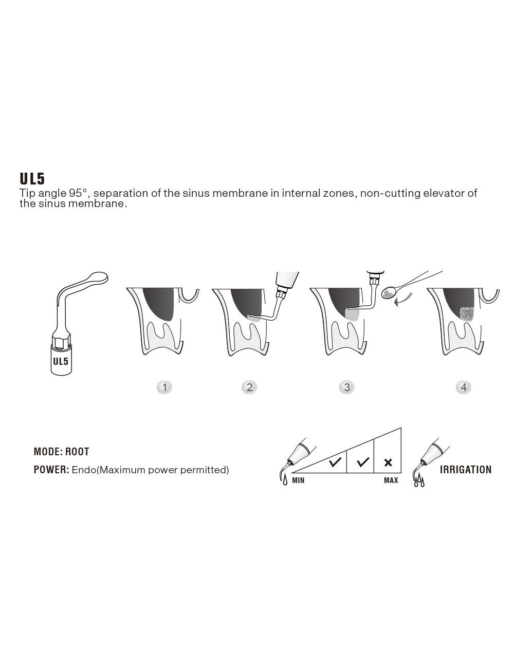 Insert UL5 pour chirurgie piezo - WOODPECKER - oofti.fr