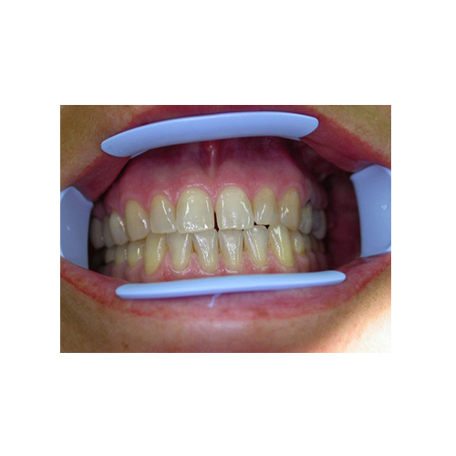 Optiview Ecarteur labial et jugal - Kerr - oofti.fr