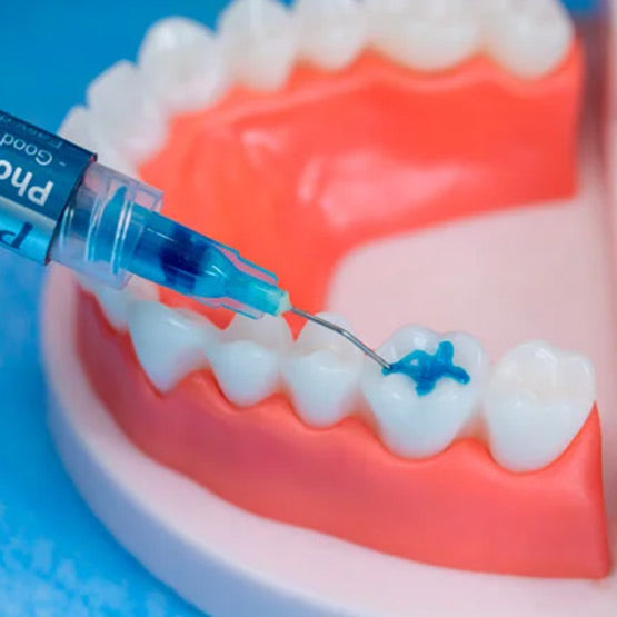 P-Echant - Gel de mordançage à l'acide phosphorique - 3 mL/seringue + 10 embouts - HUGE - oofti.fr