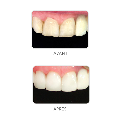 Uveneer Moules pour élaboration de facettes - ULTRADENT - oofti.fr