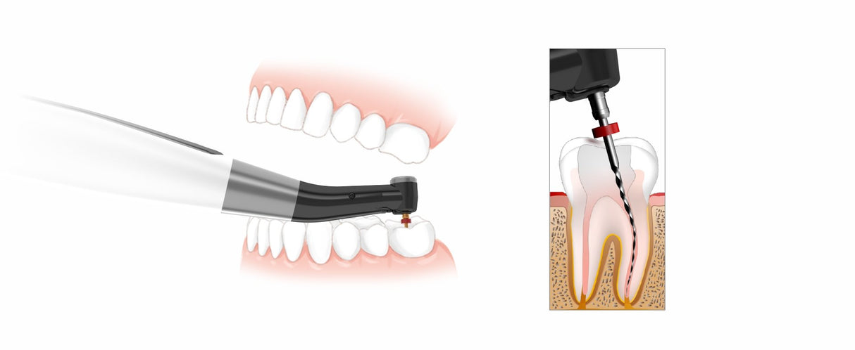 EndoMatic + boites de limes offerts - Woodpecker