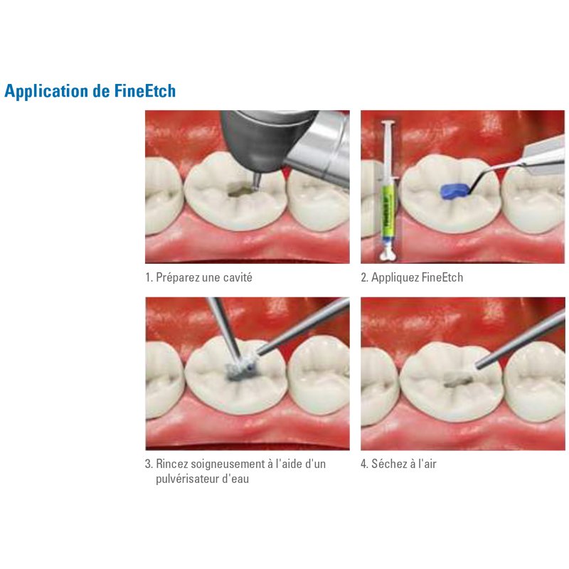 Lot de 3 seringues 5ml Fine Etch Gel de mordançage etching - oofti.fr
