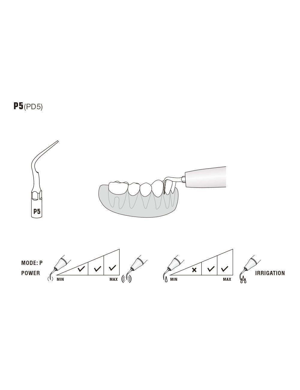 Insert P5 compatible EMS ultrarésistant UR - WOODPECKER - oofti.fr