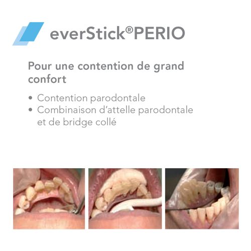 EverStick PERIO Fibre de verre - GC