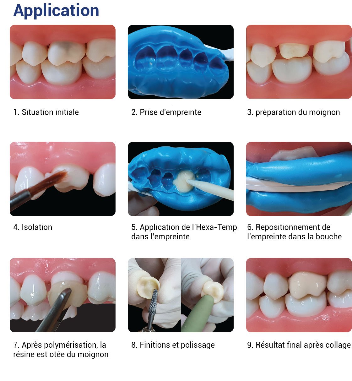 Hexa-Temp-Struct-A3 Résine pour bridges et couronnes temporaires (50ml) - oofti.fr