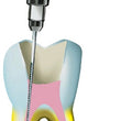 Lime endodontiques - Kent Dental