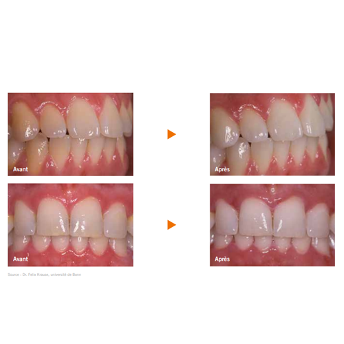 Perfect Bleach Blanchiment dentaire - VOCO - oofti.fr