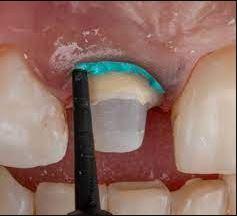 Retraction Paste - VOCO