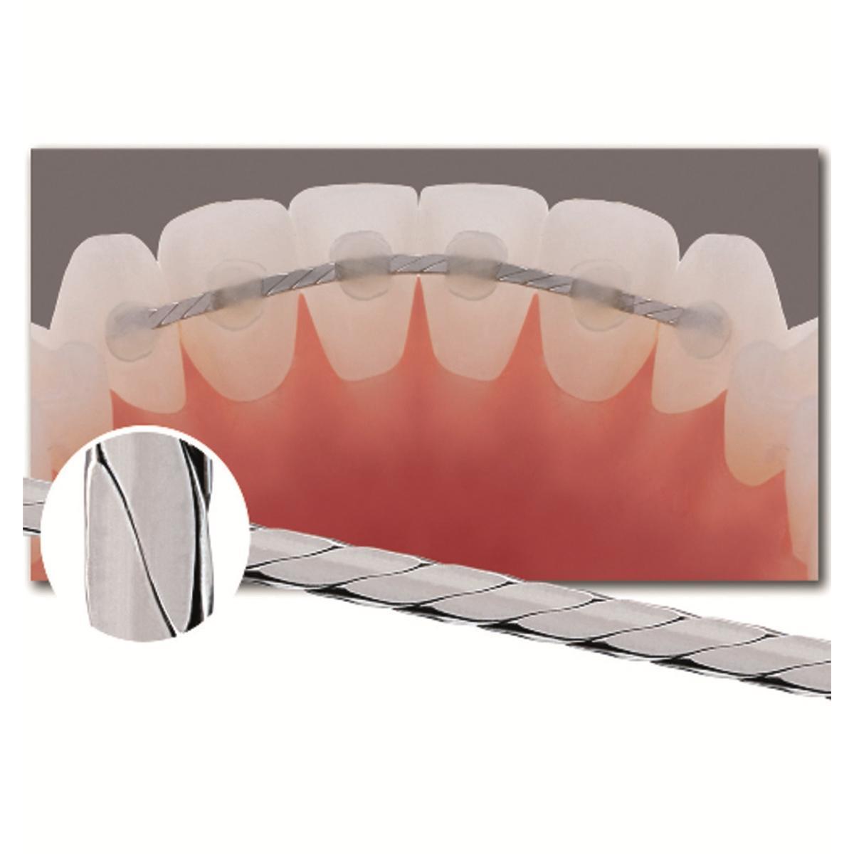 Fils de contention tressé - G&H Orthodontic