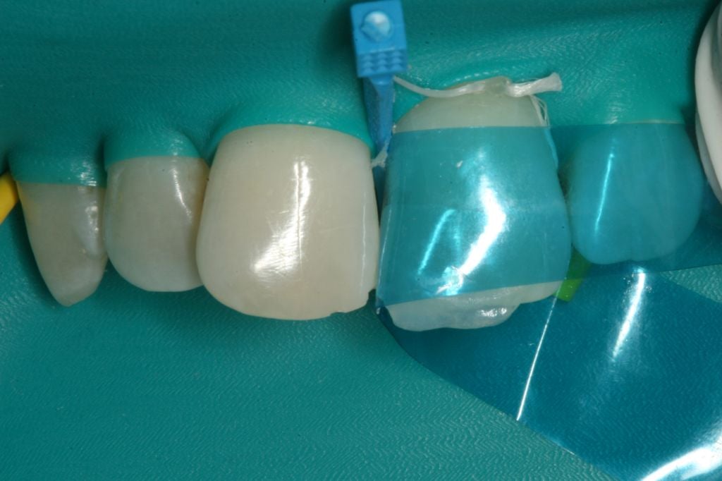 Matrice antérieure galbée offrant une courbure et une hauteur de bande optimales. Epaisseur: 0,5 mm. Hauteur de bande de 6 à 10 mm. DM Classe I. Fabricant : Garrison Dental Solutions.