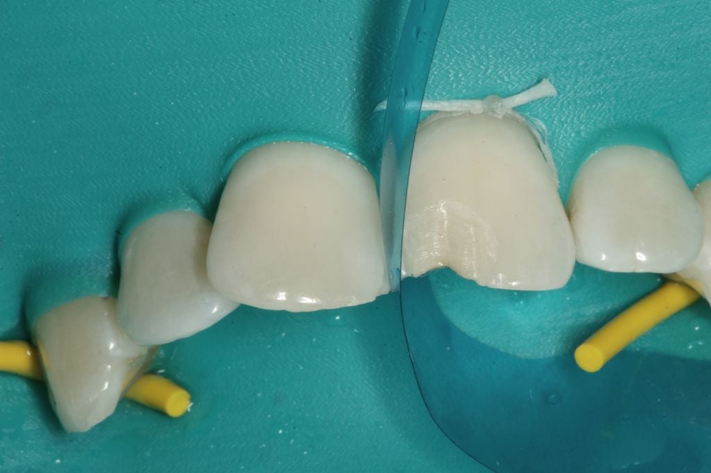 Matrice antérieure galbée offrant une courbure et une hauteur de bande optimales. Epaisseur: 0,5 mm. Hauteur de bande de 6 à 10 mm. DM Classe I. Fabricant : Garrison Dental Solutions.