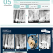 Well-Root-ST root canal sealant material -VERICOM