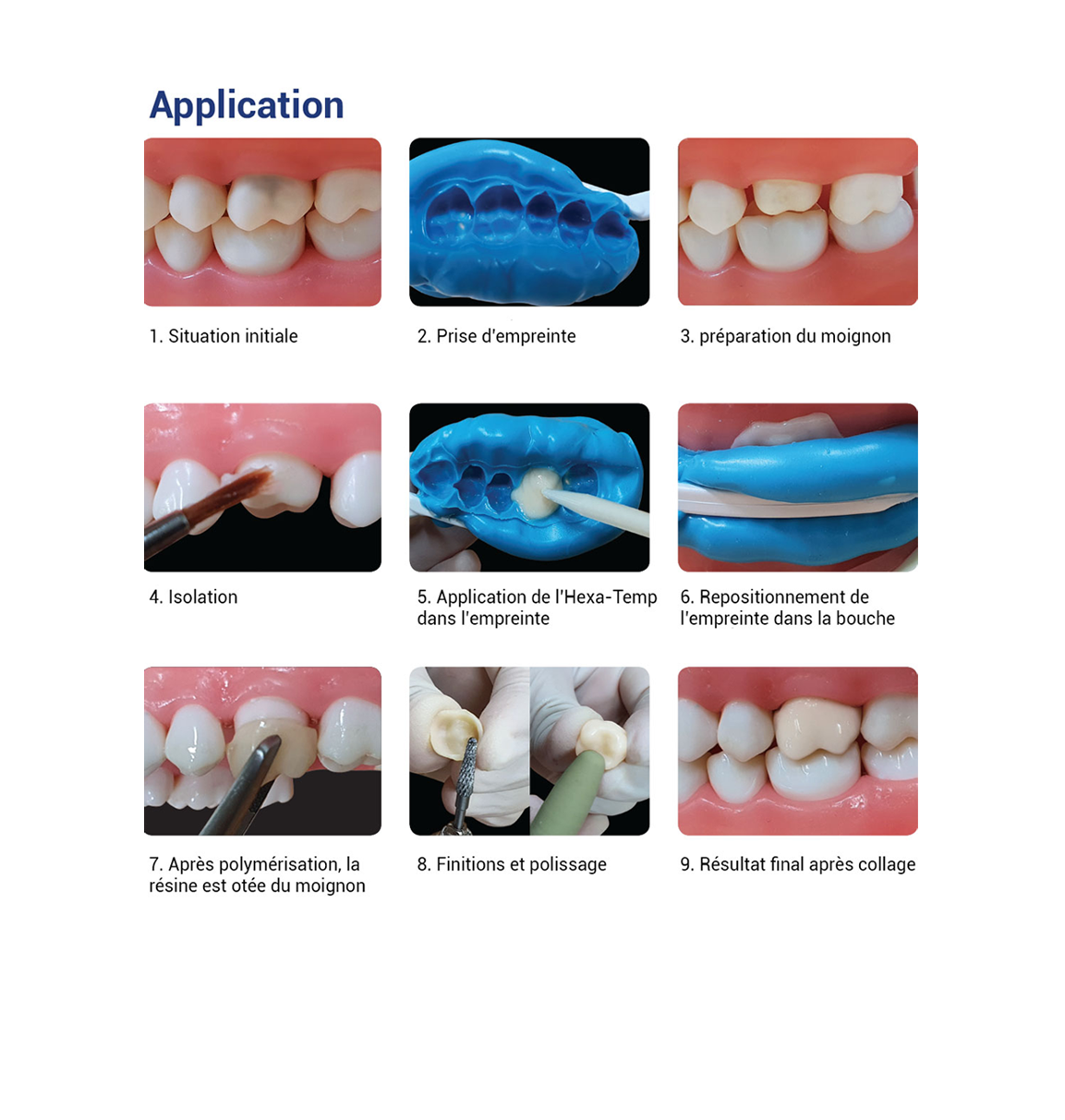 Hexa-Temp-Struct-A1 Résine pour bridges et couronnes temporaires (50ml) - oofti.fr