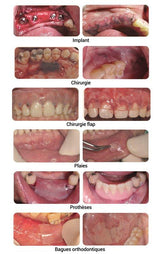 MATBEKA intra-oral boîte 20 pansements XL (50x15mm) - oofti.fr