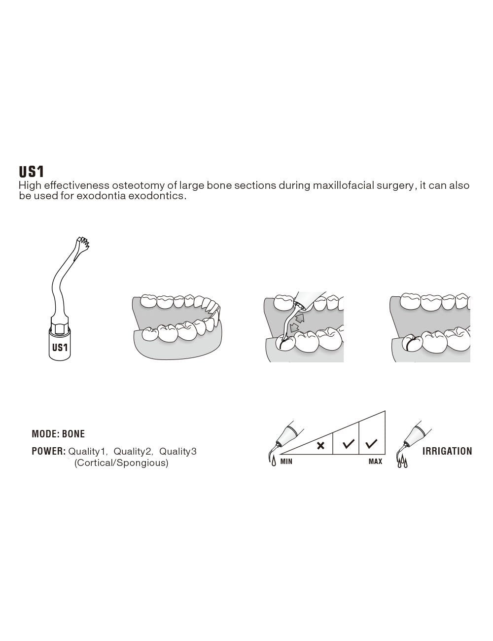Insert US1 pour chirurgie piezo - WOODPECKER - oofti.fr