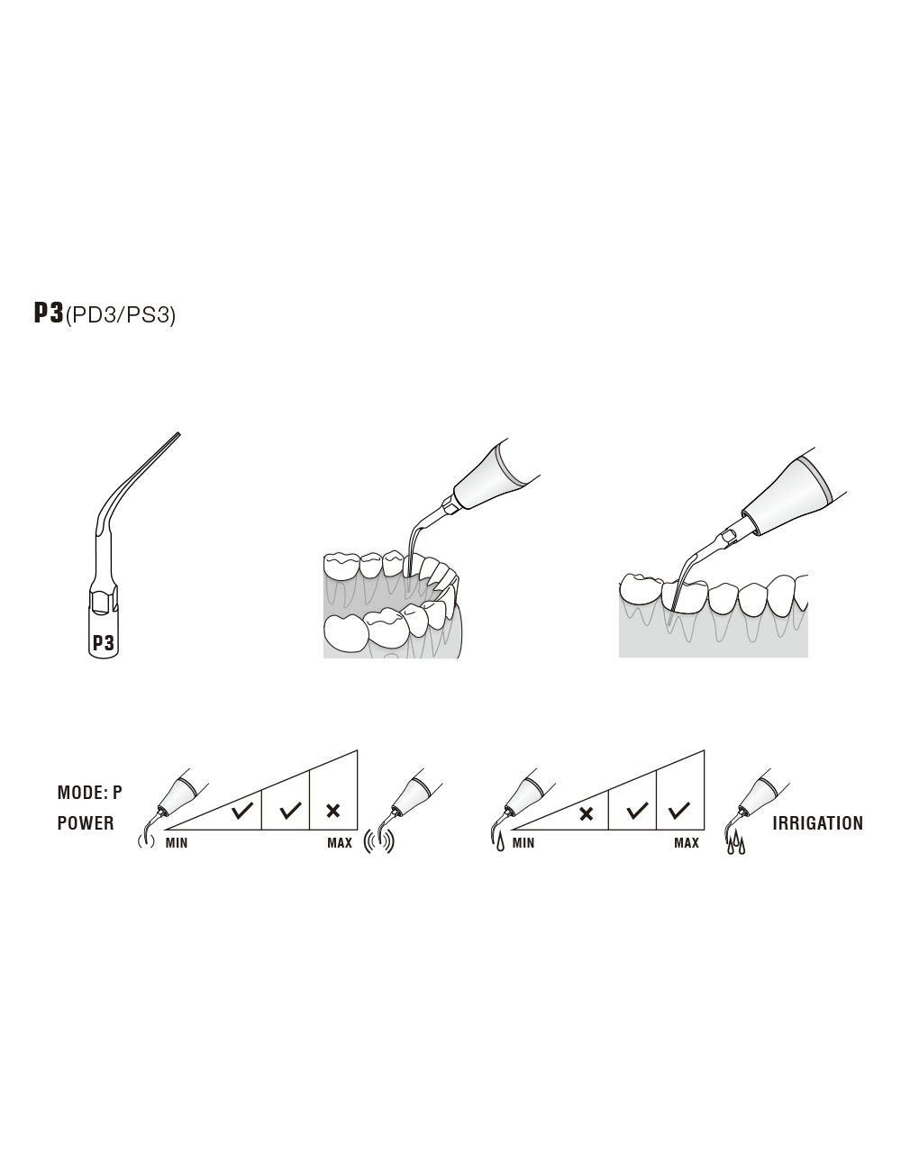 Insert P3 compatible EMS  ultrarésistant UR - WOODPECKER - oofti.fr