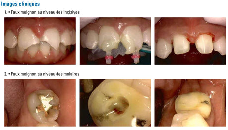 Kit Core.it Résine fluide à double polymérisation pour faux moignon - oofti.fr