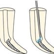 SOS lime endodontie