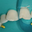 Matrice antérieure galbée offrant une courbure et une hauteur de bande optimales. Epaisseur: 0,5 mm. Hauteur de bande de 6 à 10 mm.  DM Classe I. Fabricant : Garrison Dental Solutions.